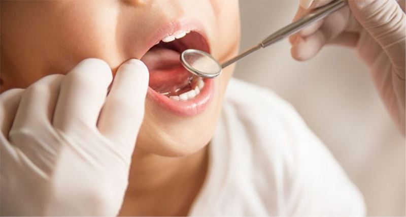 Bademcik ve geniz eti büyümesi çocuklarda diş çürüğüne neden oluyor
