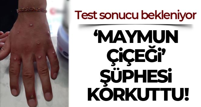 Sultangazi’de “Maymun Çiçeği” iddiası korkuttu