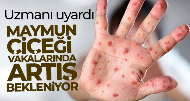 Uzmanı uyardı: Maymun çiçeği vakalarında artış bekleniyor