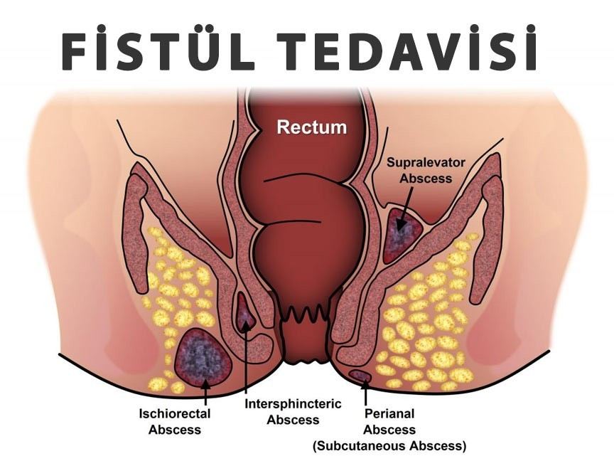 Ameliyatsız ?Fistül Tedavisi